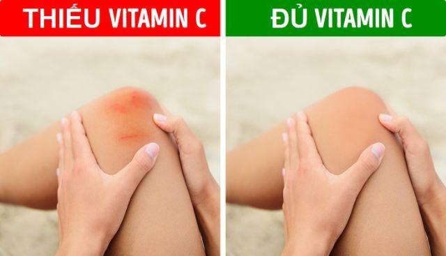 thieu-vitamin-C