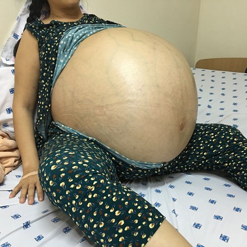 benh-nhan-voi-khoi-u-khong-lo-vhdn