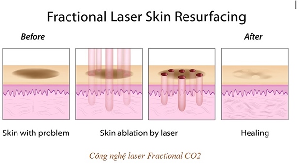 le-chuyen-giao-cong-nghe-laser-sieu-vi-diem-vanhoadoanhnhan-4